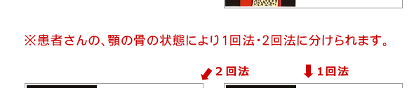 ２回法は、インプラントを包むように縫合し、インプラントを埋没した状態にします。2～6ヶ月骨とインプラントが結合するのを待ちます。