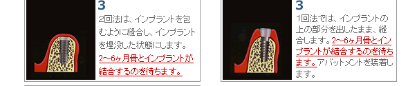 １回法では、インプラントの上の部分を出したまま、縫合します。2～6ヶ月骨とインプラントが結合するのを待ちます。アバットメントを装着します。