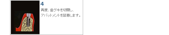 再度、歯グキを切開し、アバットメントを装着します